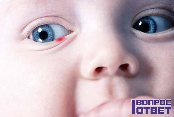 Гноится глазик у новорожденного чем лечить комаровский