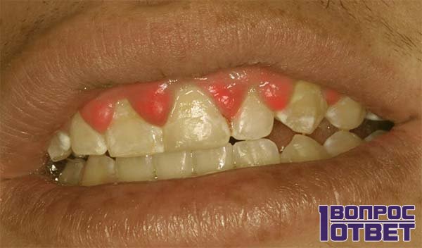 Опухоль между зубами у пациента