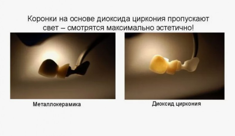 Керамика или цирконий
