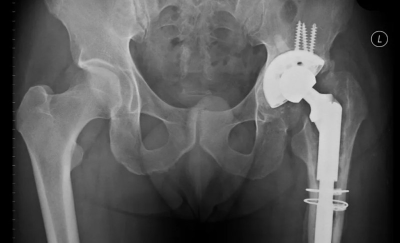 Эндопротезирование тазобедренного сустава: что это такое?